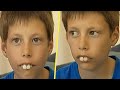В школе смеялись над его кроличьими зубами. Но через 5 лет он всех удивил!