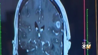 Ones For Wellness: Warning Signs of Alzheimer's - YouTube