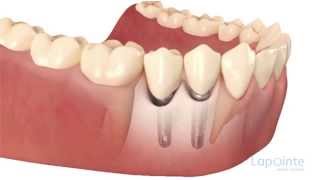 Bone grafting - Lapointe dental centres