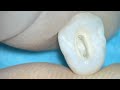 Access Cavity Preparation For Premolar
