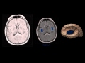 NEUROIMAGEM  - Anatomia Cerebral na Ressonância Magnética