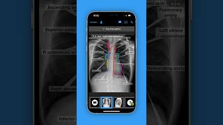 Not the first course on chest X-rays. But the coolest. 🤟🏻 Get it now! #bcvapp #radiology #thorax screenshot 1