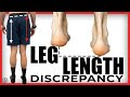 Leg Length Discrepancy: What is it? How much matters? What to do about it?