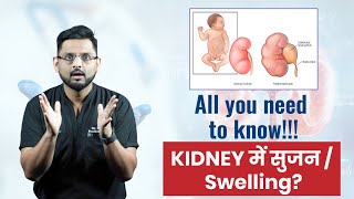 Why Do Newborns Have Kidney Swelling | Know the Causes, Symptoms, and Treatment | Antenatal Hydr...