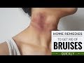 How to Heal Bruises Naturally With Home Remedies |Proven Home Remedies to Get Rid of Bruises Quickly