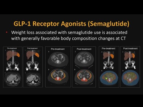 GLP-1 Body Composition—A Metabolic Win?