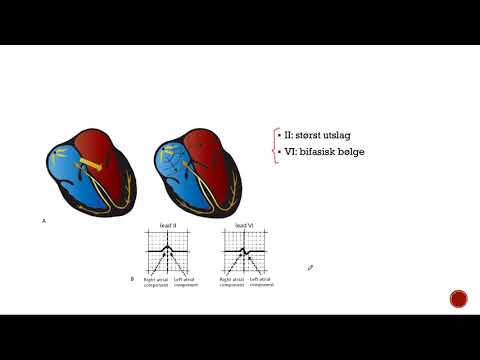 Klinisk EKG: Hypertrofi (2/2)