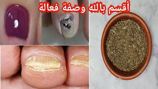 بعشبة واحدة علاج فطريات الأظافر والكزيما اريد فقط دعوة خير /أقسم بالله مجربة وفعالة 100%