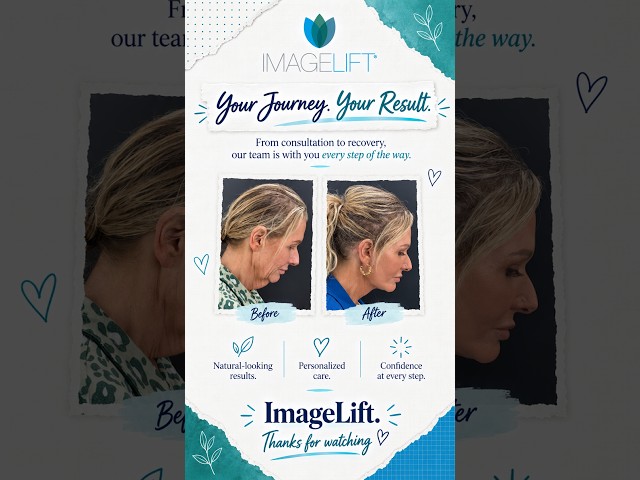 From Consultation to Recovery | Your ImageLift Journey #imagelift #facelift #deeplift #skincare