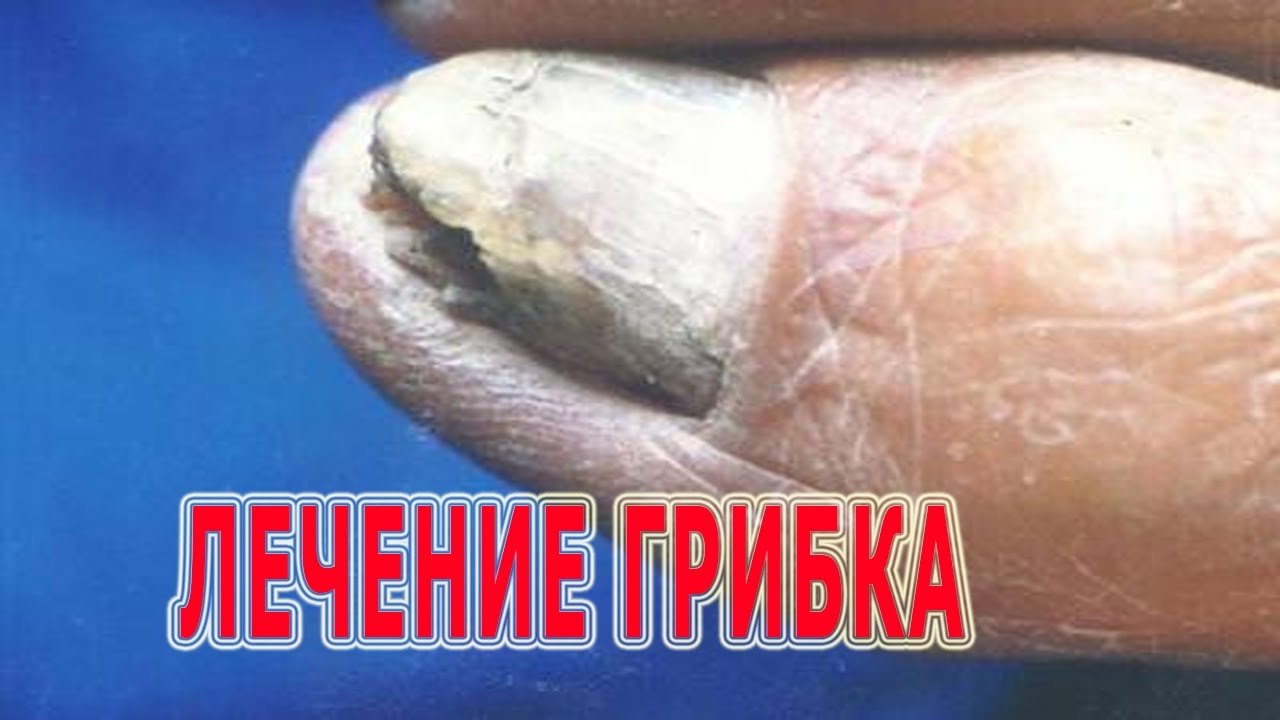 ★Как лечить ГРИБОК НОГТЕЙ на ногах дома. 4 рецепта лечения МИКОЗА ...