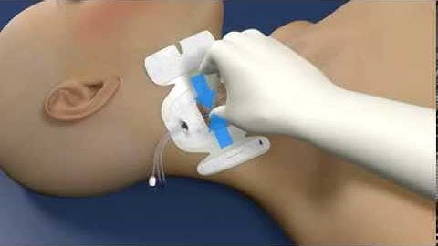 3M™ Tegaderm™ I.V. Advanced Securement Dressing - 1685 | Application and Removal