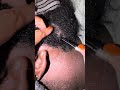 Beard Dandruff Scratching