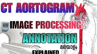CT AORTOGRAM image processing and annotation Explained