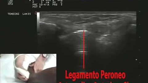 A cosa serve il legamento peroneo astragalico anteriore?