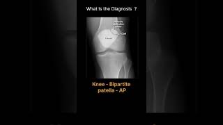 Knee - Bipartite patella - AP 181 Trauma X-ray - Lower limb gallery 1#@radiologychannel007