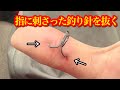 【閲覧注意‼︎】指にトリプルフックが2本刺さったから自力で抜いた【応急処置】