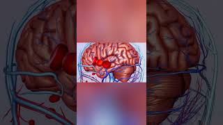 Migraine: What Happens Inside the Brain During an Attack