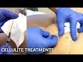 No Pain Affordable Buttock Cellulite Treatment With Subcision & Bellafill Injections | Dr Jason Emer