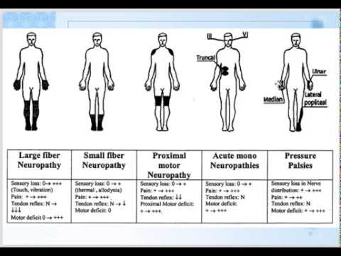 Video: Kronisk Demyeliniserende Polyneuropati Guillain-Barré