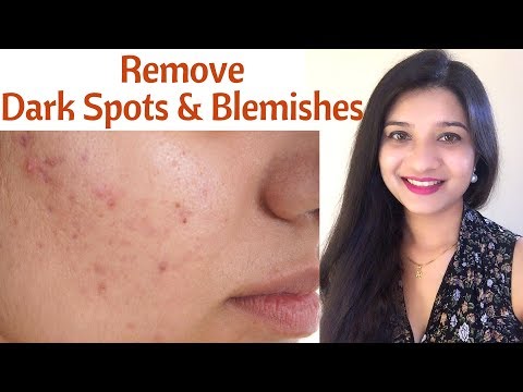 Remove Acne spots, dark spots & blemishes in Hindi | % natural face mask to get even skin tone