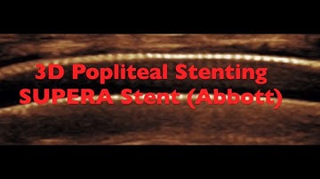 3D Popliteal Stenting: Supera Stent Abbott