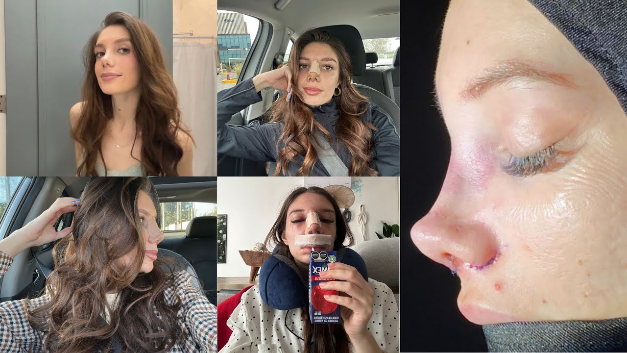 me operé la nariz - forzando el glow up