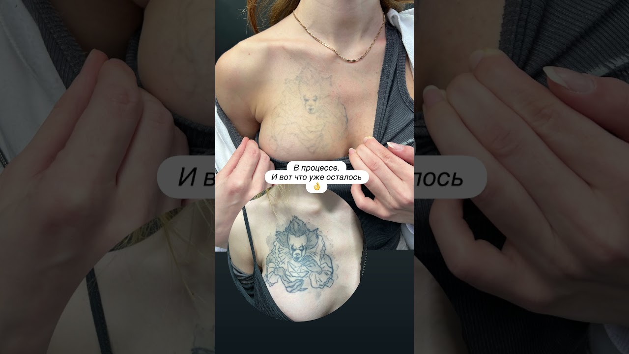 Лазерное удаление удаление тату Чебоксары ☎️89662498663 Тг канал  