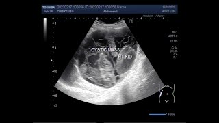 MULTILOCULAR CYSTIC NEPHROMA WITH SHRUNKEN KIDNEY.