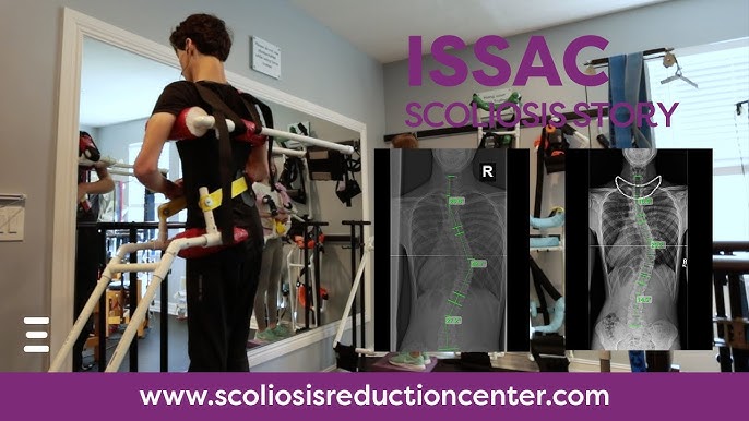 What is the Scoliosis Traction Chair?