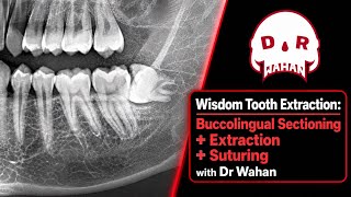 Section and Remove this Impacted Wisdom Tooth