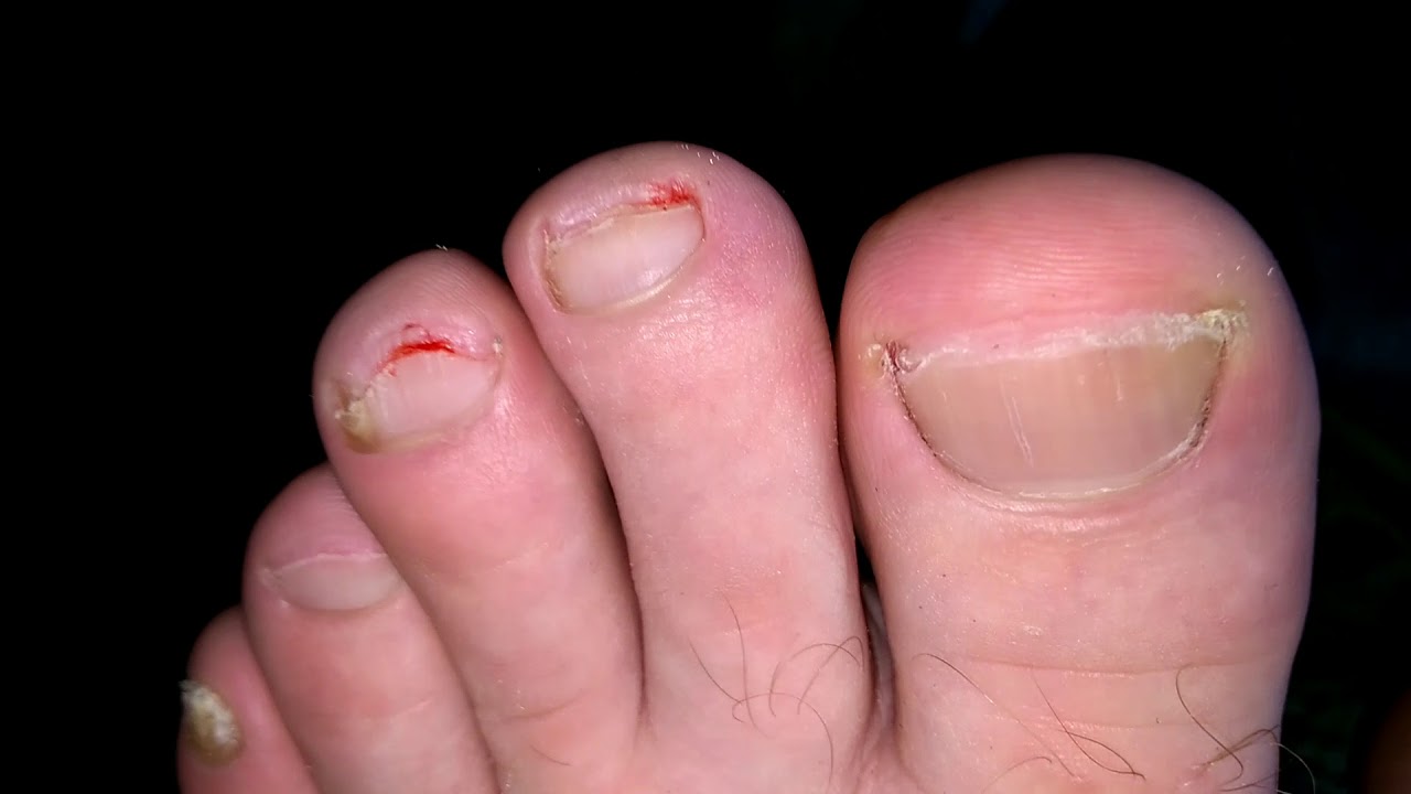 Маркин. Д.Н.Тула. Лечение грибка стопы и ногтей ФЛУКОНАЗОЛом. Часть 4 /22.11.2017 г.