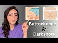 How to treat buttock acne and dark spots on buttocks | dermatologist suggests