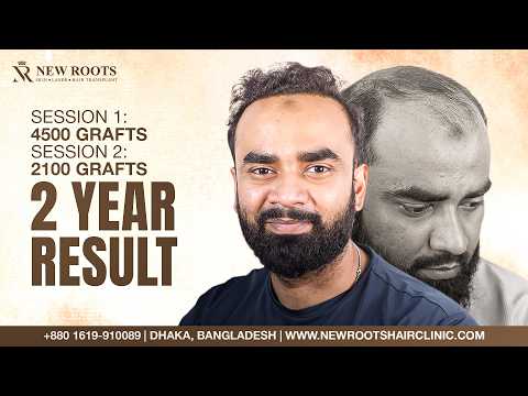 His Hair Growth Looks Better Than Ever! 🔥 | Grade 6 Baldness | Hair Transplant in Bangladesh