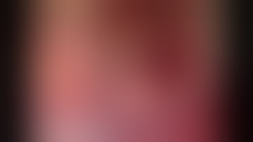 Motor Cortex Glioma Resection