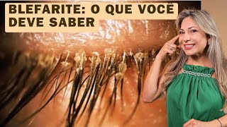 Blefarite: O Que É e Como Tratar?