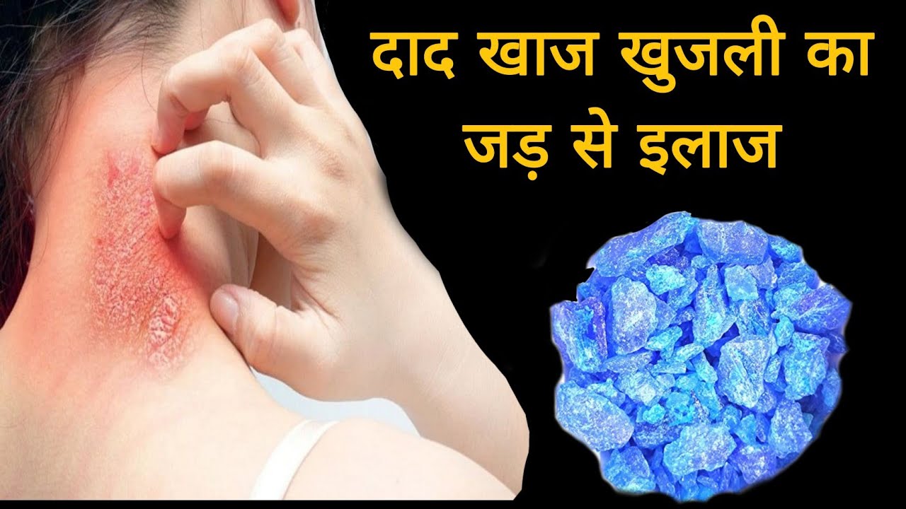 दाद खाज खुजली का रामबाण इलाज💯Fangal Infection tretment🔥