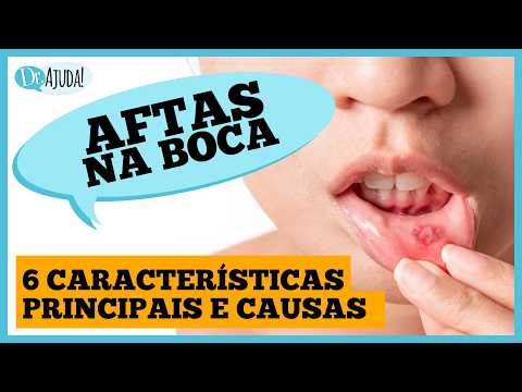 Afta dói muito: causas, sintomas e tratamentos