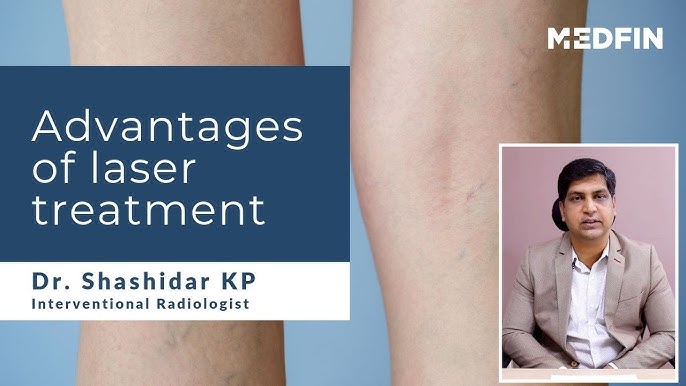Varicose Veins Laser Treatment Cost In India