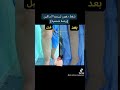 شفط دهون لبيديما الساقين ليبيديما وذمة شحمية قبل وبعد fitness تجميل health شفط_الدهون mp3