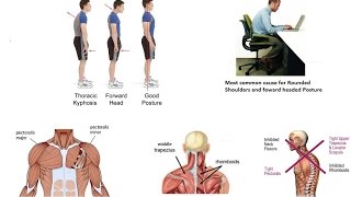 BEST OF EXERCISE SCIENCE - Upper Cross Syndrome aka Hunch Back (Corrective Exercise Program)