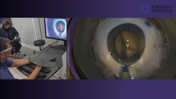 Robotic Cataract Surgery | Dr. David Chang Using ForSight