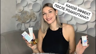 РОАККУТАН КАК Я ЕГО ПРИНИМАЮ. 2 часть. Какой итог. Отзыв