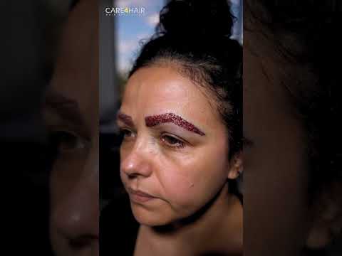 👀 Eyebrow Transplant