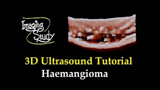3D-Ultraschall-Tutorial: Hämangiom screenshot 4