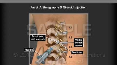 Image Guide Lumbar Facet Joint Injection