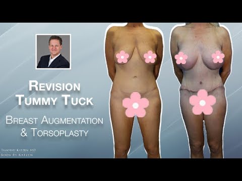 Breast Augmentation with a Revision Tummy Tuck and a Torsoplasty