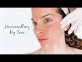 VLOG: Microneedling for Acne Scars and Skin Rejuvenation!