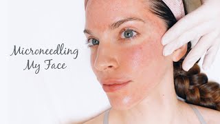 VLOG: Microneedling for Acne Scars and Skin Rejuvenation