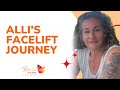 Alli's Facelift Journey | RevitalizeinTurkey