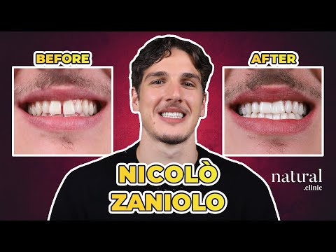 Nicolo Zaniolo's Dental Treatment: A Smile Makeover #NicoloZaniolo #Hollywoodsmile #smilemakeover